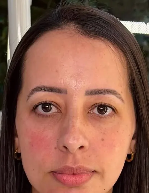 Depois do Full Face, frontal