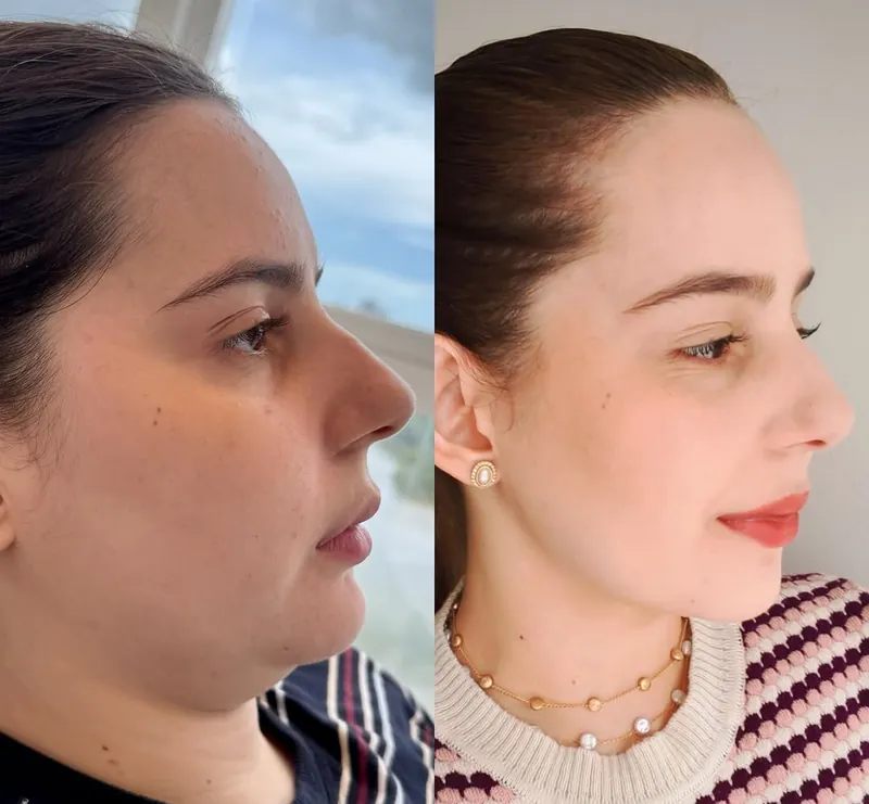 Resultado após três meses